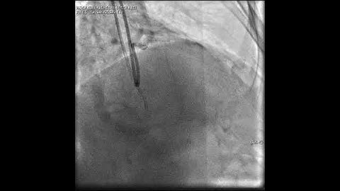 Aortic dissection and radial rupture during retrograde CTO PCI: Management of complications VİDEO 1