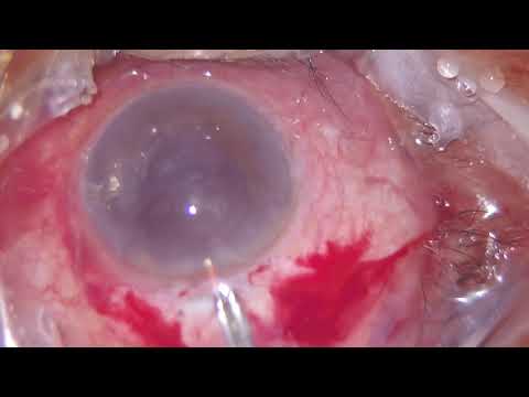 AIOC2021-VT107-Button prolapse of Hard nucleus in MSICS