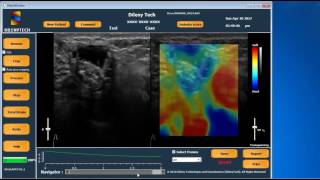 US-Elasto V1.1 Quick Demo: Breast ultrasound elastography screenshot 3