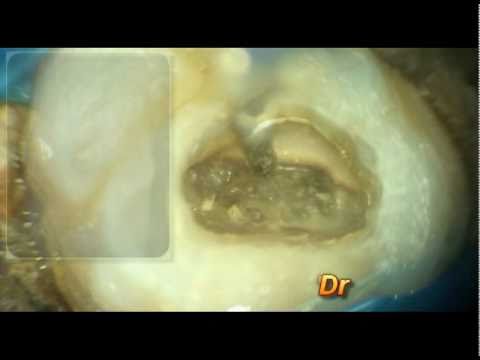 calcificazione nella prostata calcificazione nella prostata