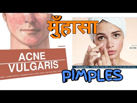 ACNE VULGARIS(मुँहासा ) , Cause , Homeopathic medicine