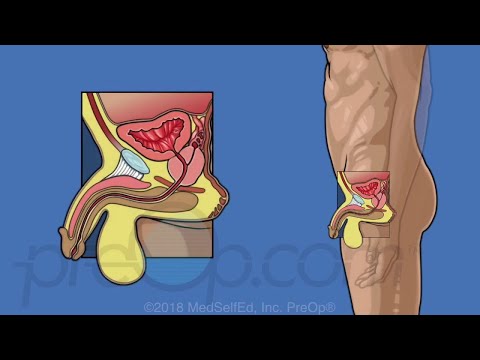 Vídeo: Lo Que Necesita Saber Sobre La Cirugía De Próstata