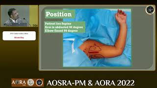 PNS guided Axillary brachial plexus block