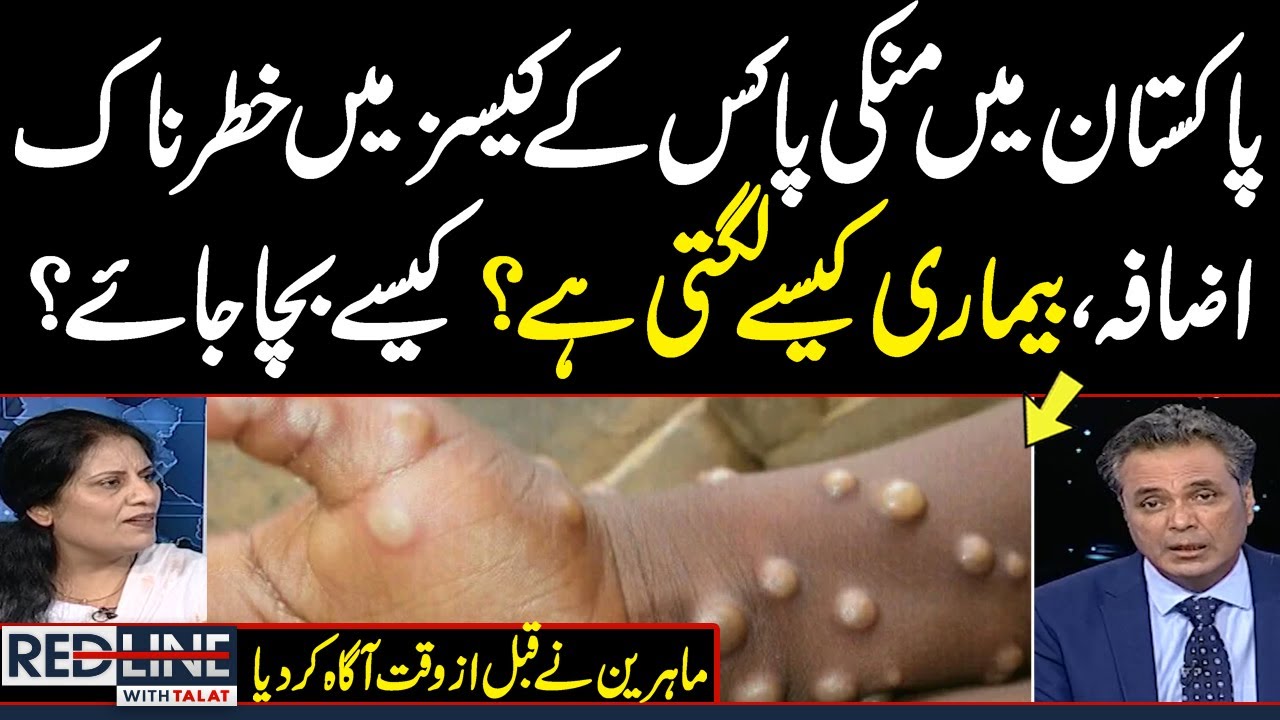 Monkeypox alert issued in Pakistan | Doctor Naseem Akhtar gives ...