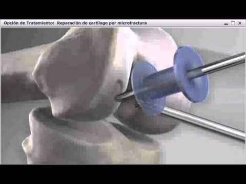 Microfracturas Rodilla - YouTube