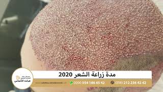 مدة زراعة الشعر 2020