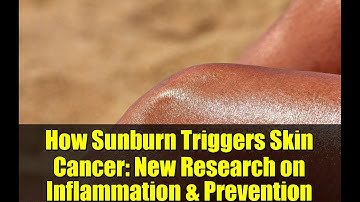 How Sunburn Triggers Skin Cancer: New Research on Inflammation & Prevention