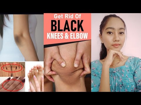 Video: Dark Knees: Penyebab Dan Obat Pencerah Alami