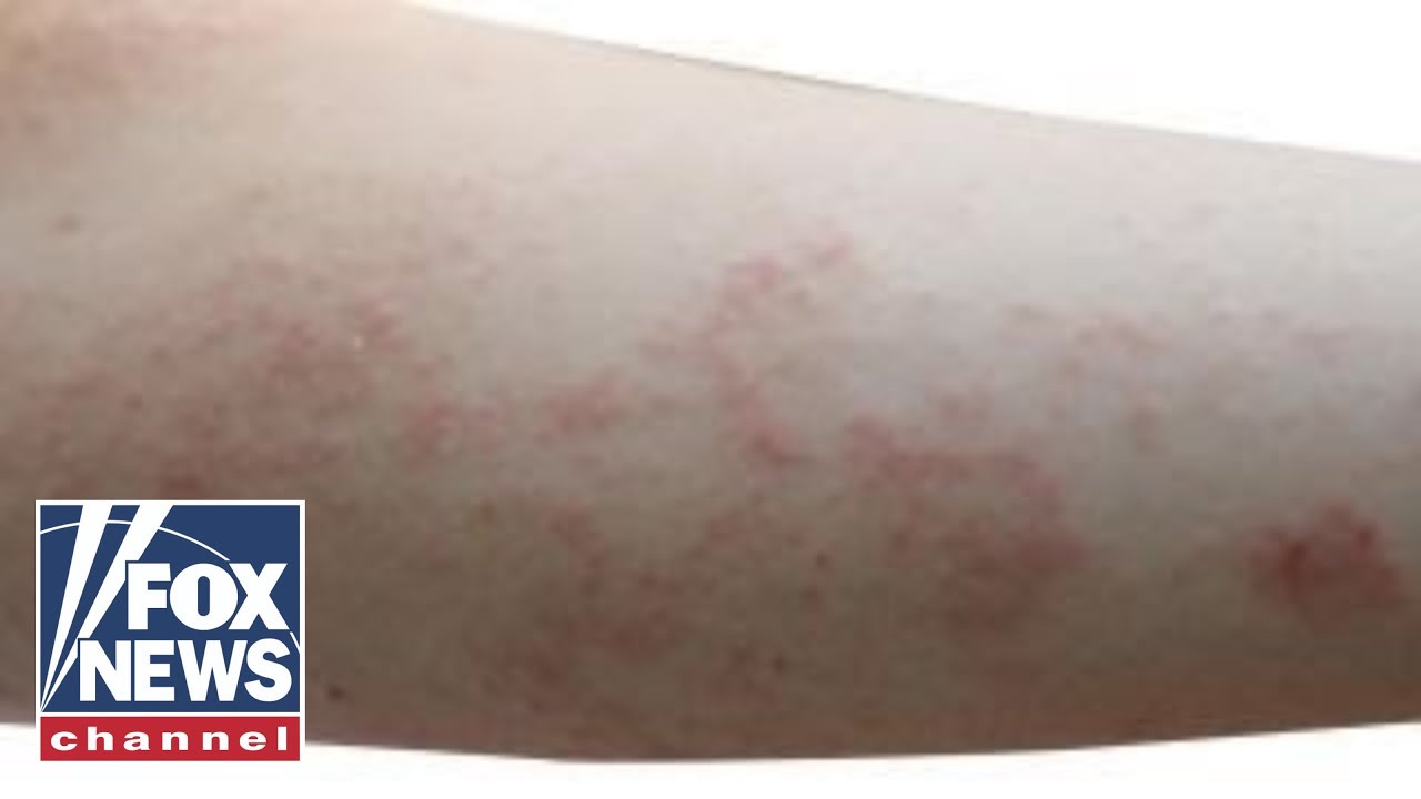 Scabies Rash On Arms