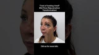 Mid-face volume loss is one of the first signs of ageing.