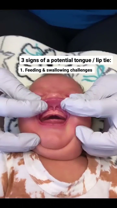 3 Signs of a Potential Tongue Tie