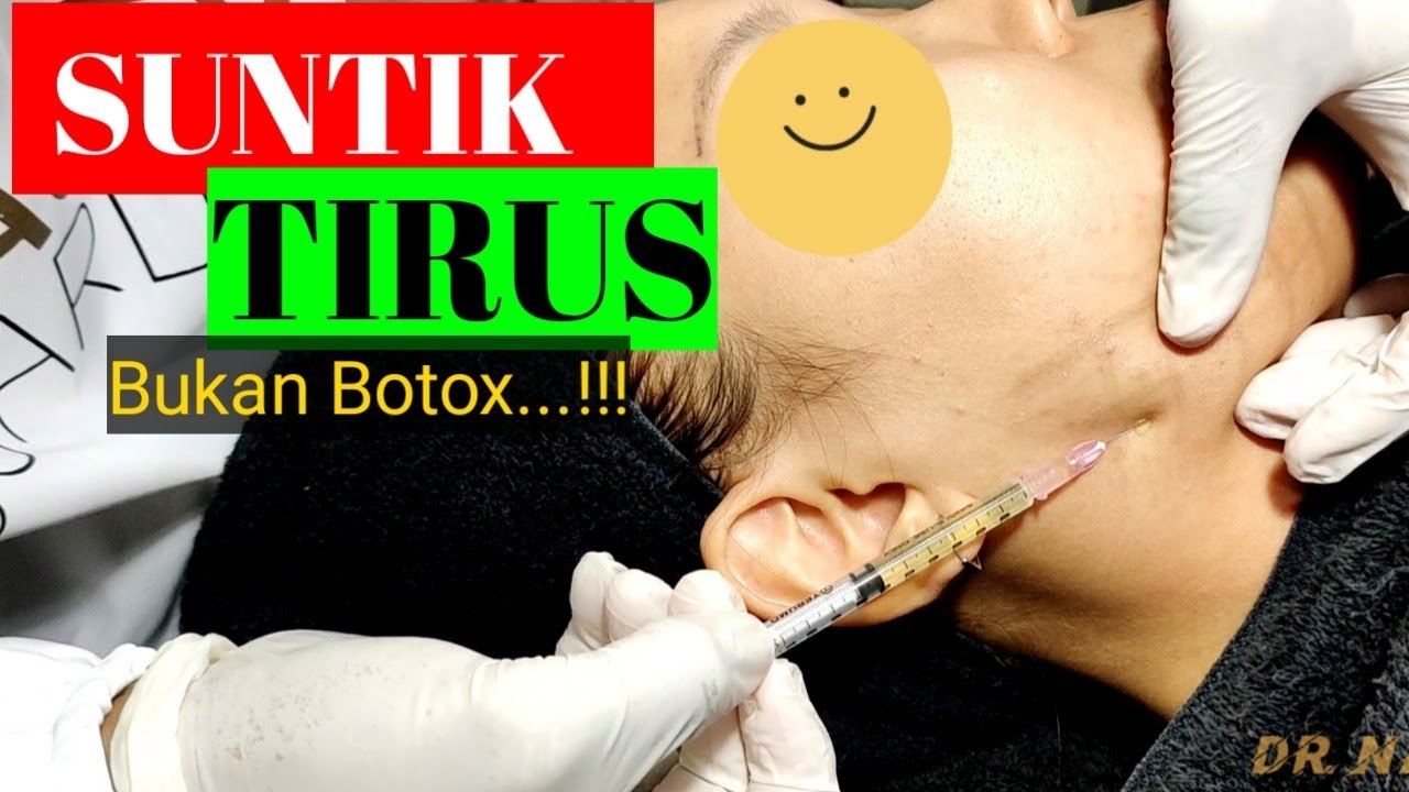 Lipolisis, Suntik Lemak Wajah Natasha Skin Clinic Center dr. Nata