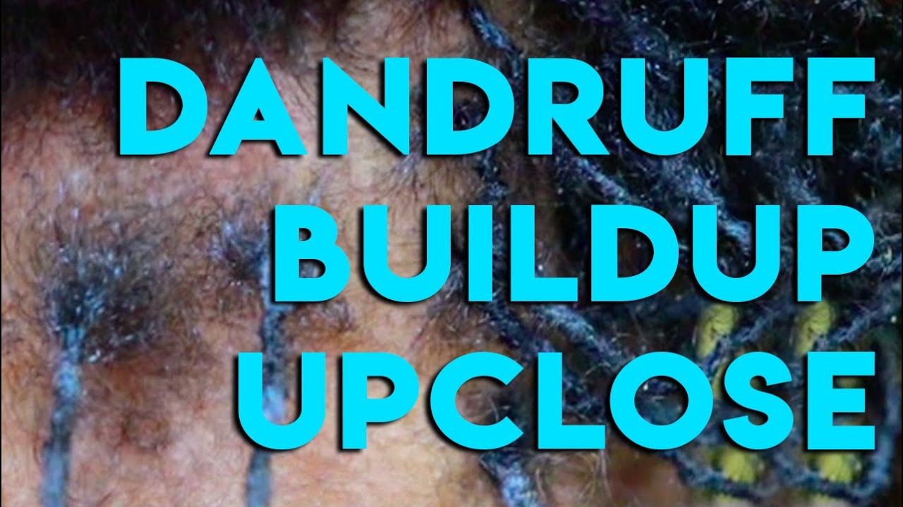 Can Sweat And Dandruff Cause Buildup YouTube