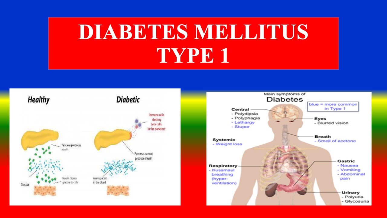 DIABETES MELLITUS TYPE 1 – Definition ,types ,cusses ,Pathophysiology ,signs diagnoses, treatment DIABETES MELLITUS TYPE 1 – Definition ,types ,cusses ,Pathophysiology ,signs diagnoses, treatment