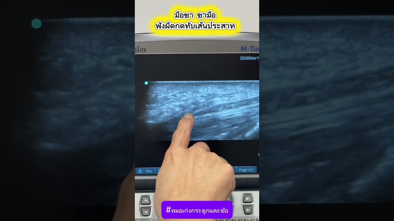มือชา ชามือ พังผืดกดทับเส้นประสาท