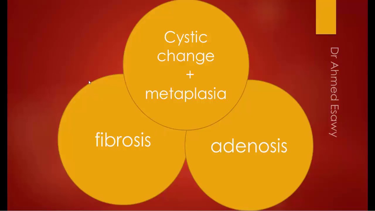 atipikus ductalis hyperplasia és papilloma)