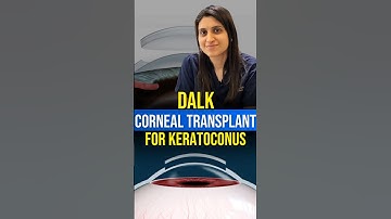 DALK Corneal Transplant For Keratoconus | (Deep Anterior Lamellar Keratoplasty)