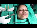 Facial Feminization Surgery (FFS), Male to Female transgender face surgery