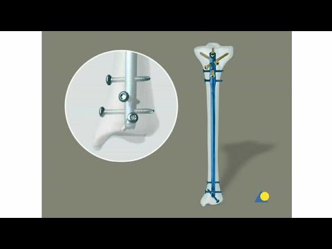 Tibia - Fracture - Intramedullary Nailing with the Expert Tibial Nail (With Reaming)