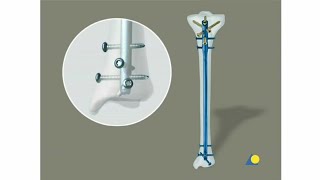 Tibia - Fracture - Intramedullary Nailing with the Expert Tibial Nail (With Reaming)