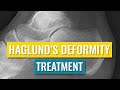 Haglund's Deformity Treatment
