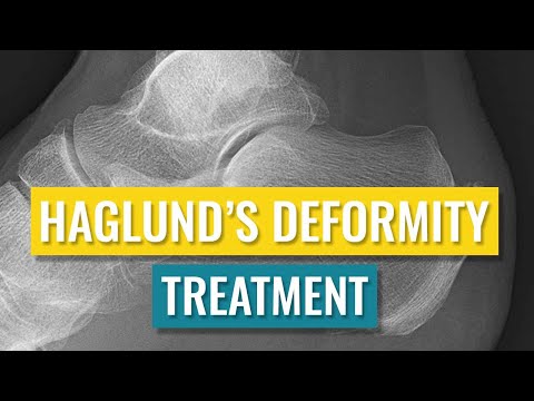 Video: Deformitas Haglund: Penyebab, Gejala, Dan Diagnosis