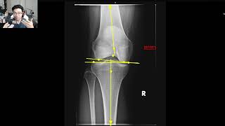 Gonstead Knee Analysis - AP Knee