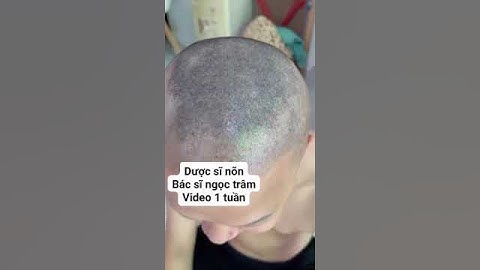 rụng tóc mảng, trụi tóc.bạn giang nguyễn 29 tuổi