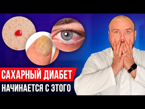 Вы можете не знать, что у вас диабет! Первые признаки сахарного диабета 2 типа