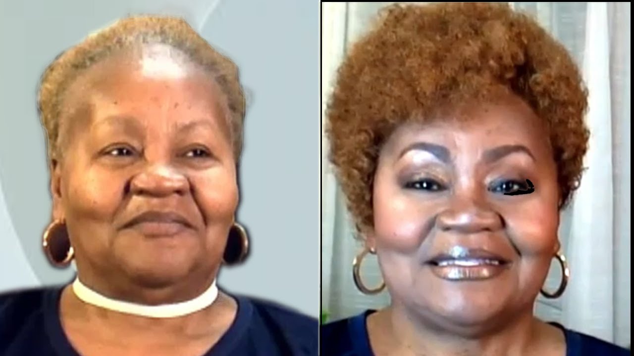 Bald Forehead Thin Hairline NO WORRIES 👍