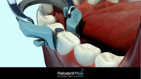 Palodent Technique full video