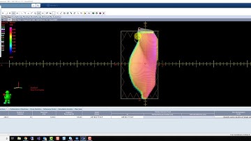 Varian Eclipse Breast Planning (Irreg. Surface Comp.)