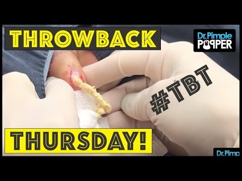 Reminiscing W/ Dr. Pimple Popper, TBT Pt.8