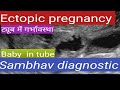 Ectopic  pregnancy #Tubal pregnancy # ट्यूब में गर्भावस्था#sambhavdiagnostic