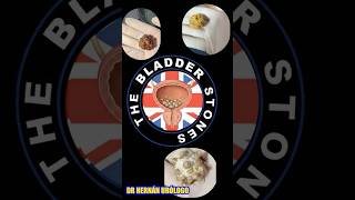 The BLADDER STONES #urology #bladderstones #prostate #meme #humor #prostata #piedrasderiñon #mexico