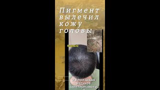 Трихопигментация - лечение кожи головы