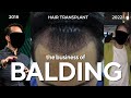 The Dreadful Business of Balding &amp; Hair Loss