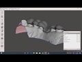 Meshmixer dental implant surgical guide