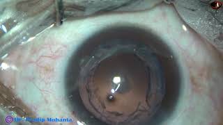 Managing a Posterior Subcapsular Cataract with very soft Nucleus : Pradip Mohanta, 11th Sept,  2020