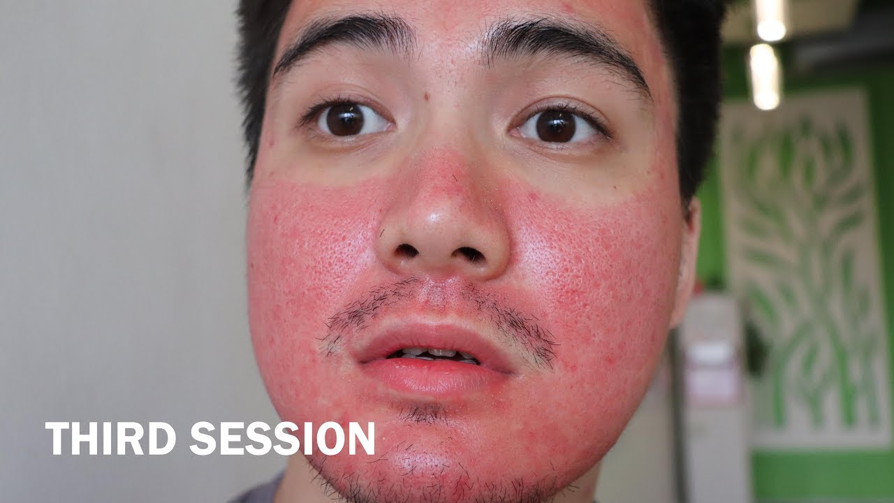 My Third Fractional Co2 Laser Experience Philippines Acne Scar