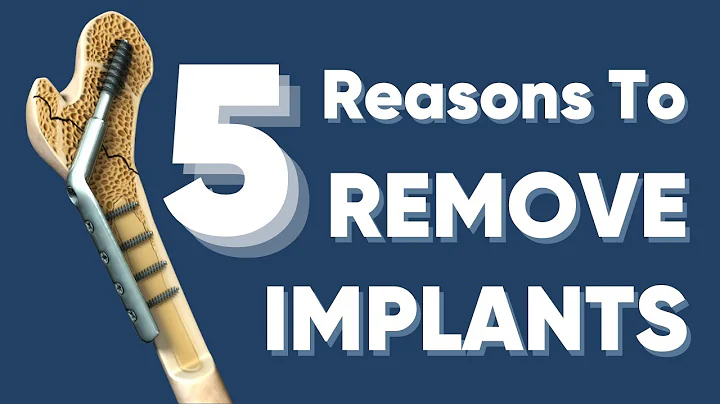 Is it necessary to remove the plate/screw/rod after the fracture heals? implant removal after fracture heals