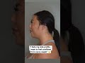 How To Lose Facial Fat | Buccal fat removal and chin liposuction #beforeandafter