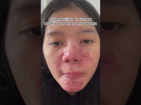 AKHIRNYA SEMBUH