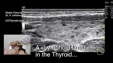 Thyroid Ultrasound. A lymphoid lobules in the thyroid... // Master Class by Dr. A. Ushakov