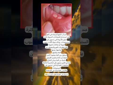 بقع بيضاء بفمك السبب يمكن يكون في دوائك اكسبلور معلومات لايك تاريخ ترند SHORTS