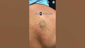 Before & After 8 Tattoo Removal Treatments!🤩
