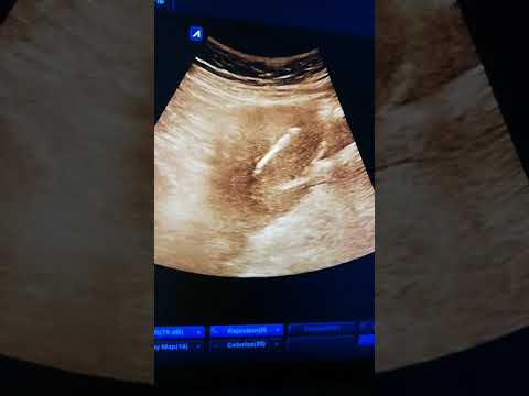 سؤال الكل هل يمكن ترك اللولب في الرحم مدة تتجاوز الاربع سنوات