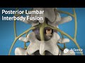 Posterior lumbar interbody fusion plif