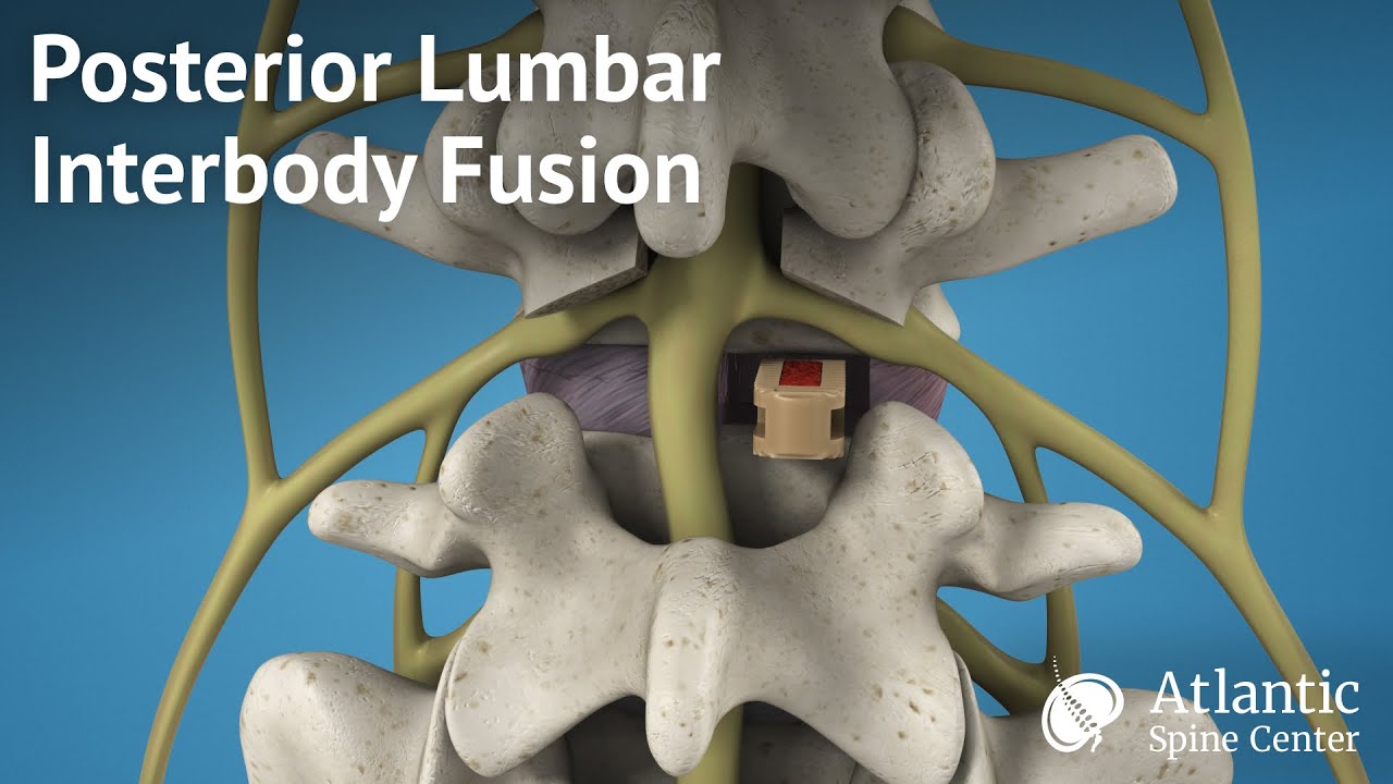 Posterolateral Fusion Surgery