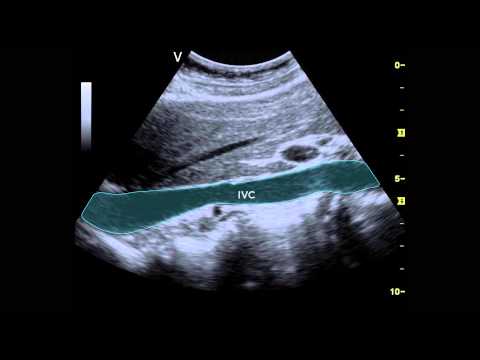 Ultrasound of the IVC